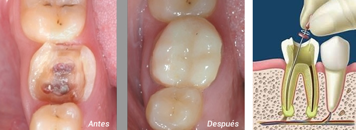 Pestaña endodoncia